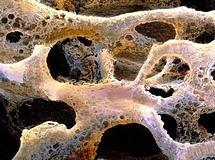 Osteoporoza neden olan hastalıklar ve ilaçlar nelerdir? Korunma yöntemleri