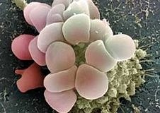 Altuzan, yumurtalık kanserinde etkinliğini kanıtladı