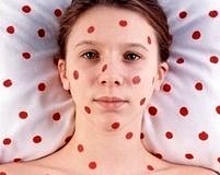 Kızamık virüsünün yarattığı hayati riskler bilinenden fazla