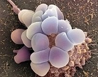 NICE, yumurtalık kanserine karşı kan tahlili önerdi