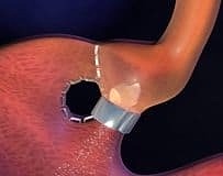 Gastroplasti obezite tedavisinde etkili bir yöntem mi?