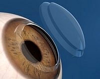 DALK yöntemiyle tek kornea ile iki hasta tedavi edildi