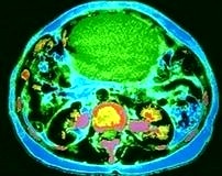 Prof. Dr. Pignata: ‘Hastanın tercihini tedavi sürecine katmalıyız’