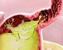 Uzun süreli reflü tedavisinde hangi yöntem daha etkili