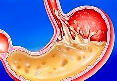 Gastroözofagial reflü ve tedavide pratik noktalar