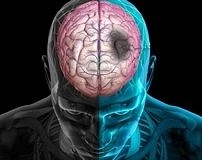 Statin tedavisi gençlerde inme nüksünü engelleyebilir