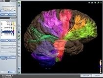 Tam zamanlı MR, beyin cerrahisinde başarıyı arttırıyor