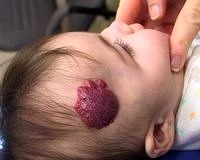 Bebeklerde infantil hemanjiyom için yeni bir tedavi