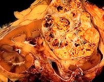 Böbrek kanseri tedavisinde paradigma değişimi…