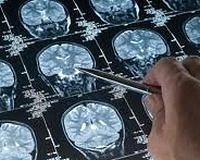 Egzersiz beyinde küçülmeyi engelliyor