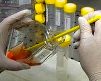 Serebrospinal sıvı testiyle erken evrede Alzheimer teşhisi