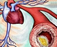 Koroner kalsiyum düzeyi kalp krizinin önemli bir göstergesi