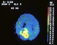 Görüntüleme ilaçları kanser teşhisinde kullanılabilir mi?