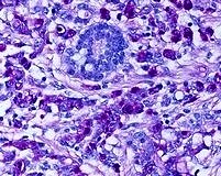 Nöroendokrin tümörlerde ilk biyolojik tedavi