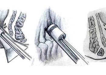 Hemoroid Band Ligasyonu tedavisinin faydaları