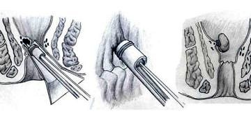 Hemoroid Band Ligasyonu tedavisinin faydaları