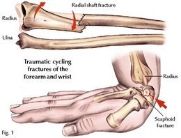 Alci Nasil Cikartilir Arm Fracture Youtube