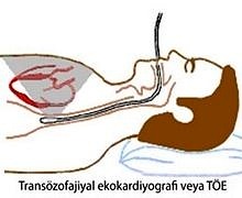 transozofajiyal ekokardiyografi