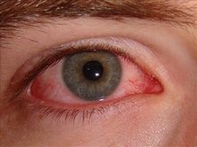 baharda-göz-alerjisi
