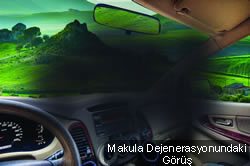 makula dejenerasyonu