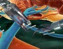 Tıpta bir ilk: NOSETS yöntemiyle vajinadan böbrek nakli