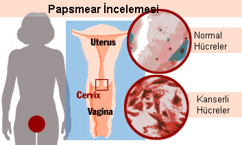 hpv virus and normal pap)