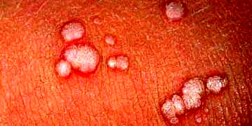HPV virüsü nasıl bulaşır? Rahim ağzı kanserinin tanı ve tedavisi