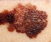 Solaryumun kansere neden olduğu kesin olarak kanıtlandı