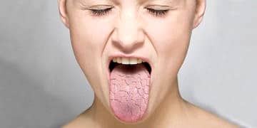 Sjögren sendromu nedir? Neden olur? Belirtileri ve tedavisi