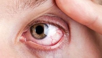 Göz seyirmesi gizli astigmat ve miyopun habercisi olabilir