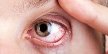 Göz seyirmesi gizli astigmat ve miyopun habercisi olabilir