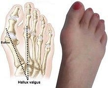 halluks-valgus
