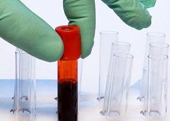 Meme kanseri teşhisinde basit ve etkili yeni bir kan testi