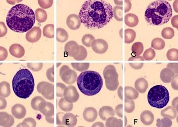 Miyelom’un tedavisinde umut verici gelişmeler