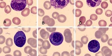 Miyelom’un tedavisinde umut verici gelişmeler