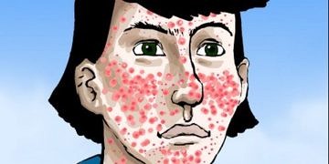 Akne vulgaris tanı ve tedavisi