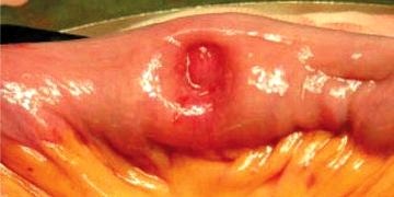 Alt GİS kanamaları tanı ve tedavisi