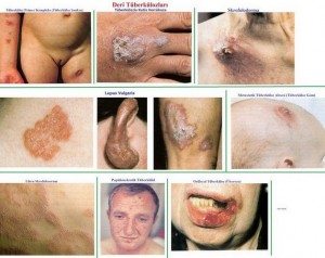 deri-tuberkulozlar