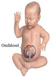 dogumsal-karın-duvari-defektleri