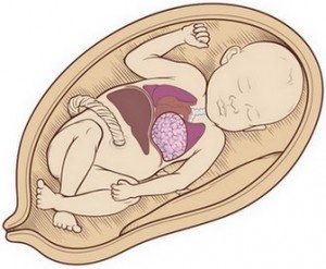 dogumsal-karın-duvari-defektleri4
