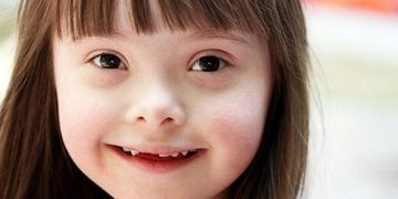 Her iki down sendromlu bebekten birinin kalbi hasta