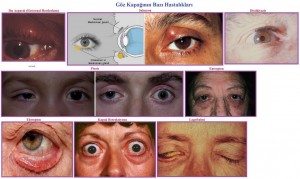 goz-kapagi-hastaliklari