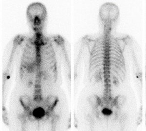 kemik-sintigrafi