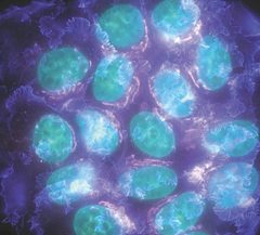 meme-kanseri-hucreleri