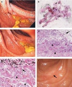 peptik-ulser-doku-mide