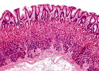 Peptik ülser tanı ve tedavisi…