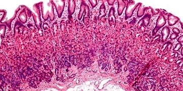 Peptik ülser tanı ve tedavisi…