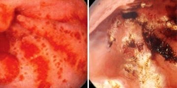 Üst GİS Kanamaları tanı ve tedavisi