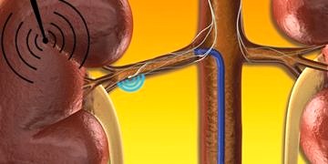 Radyo dalgaları hipertansiyon tedavisinde etkili bulundu