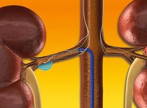 bobrek-tedavisi